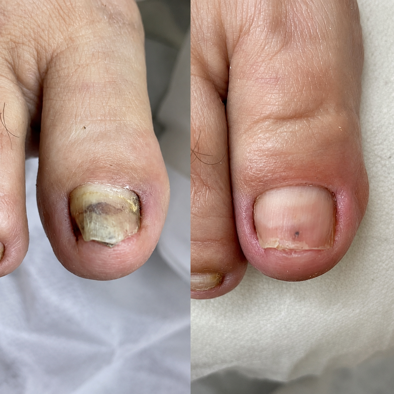 Tratamiento Anti Hongos 7 Días - Recupera unas uñas sanas y fuertes.