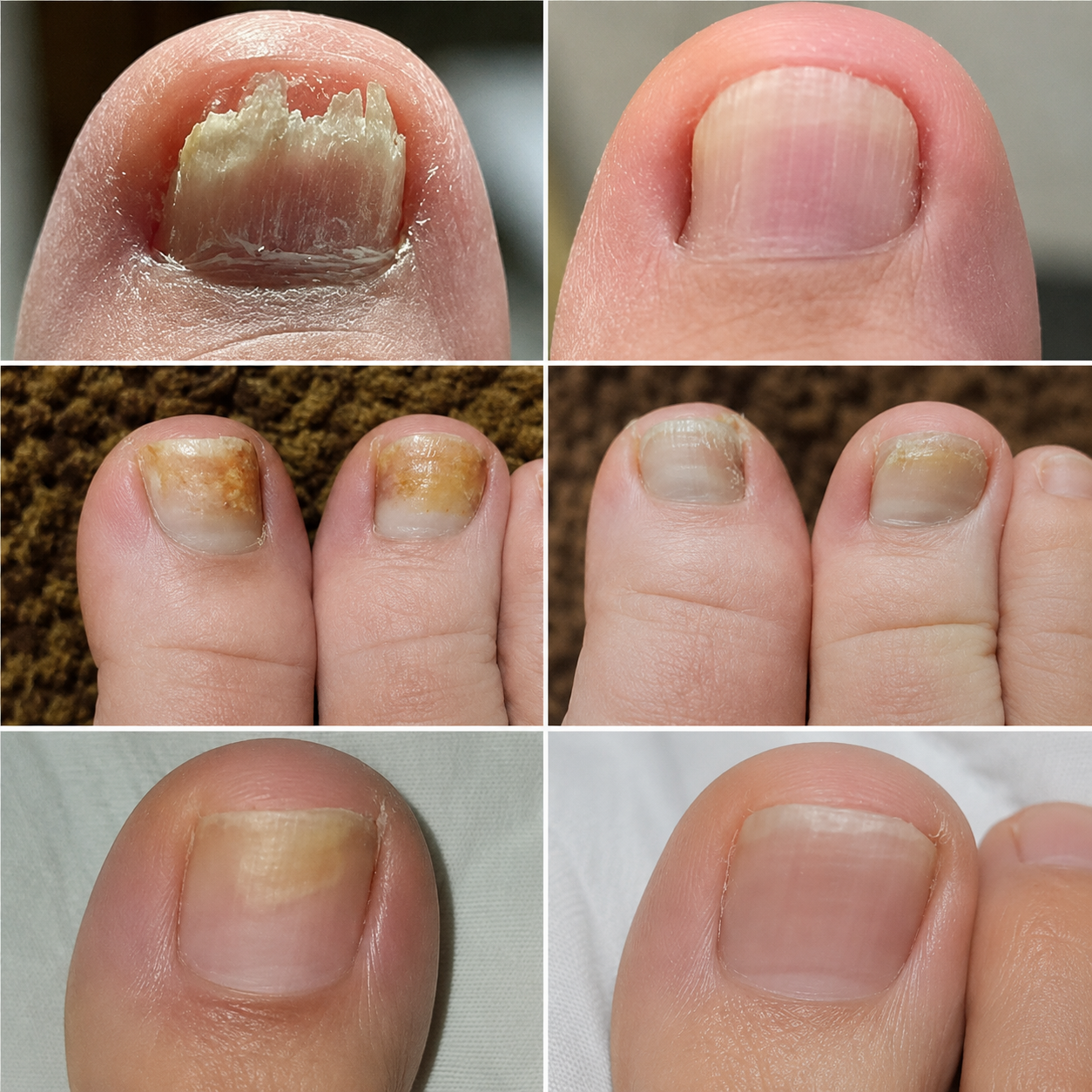 Tratamiento Anti Hongos 7 Días - Recupera unas uñas sanas y fuertes.