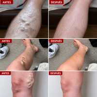 Parche para las varices - Piernas más cómodas de forma natural