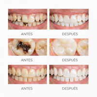Sérum Reparador Dental – Repara el daño rápido