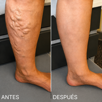Parche para las varices - Piernas más cómodas de forma natural