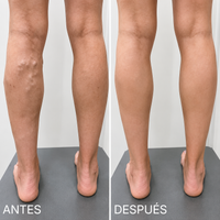 Parche para las varices - Piernas más cómodas de forma natural