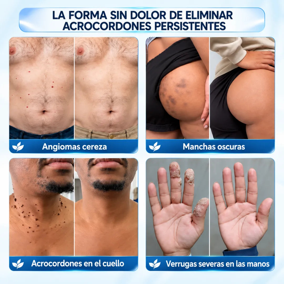 ClaraMaison® CREMA BORRADORA DE ACROCORDONES Y MANCHAS -Sin dolor y sin cicatrices · Crema de alta calidad contra las imperfecciones de la piel