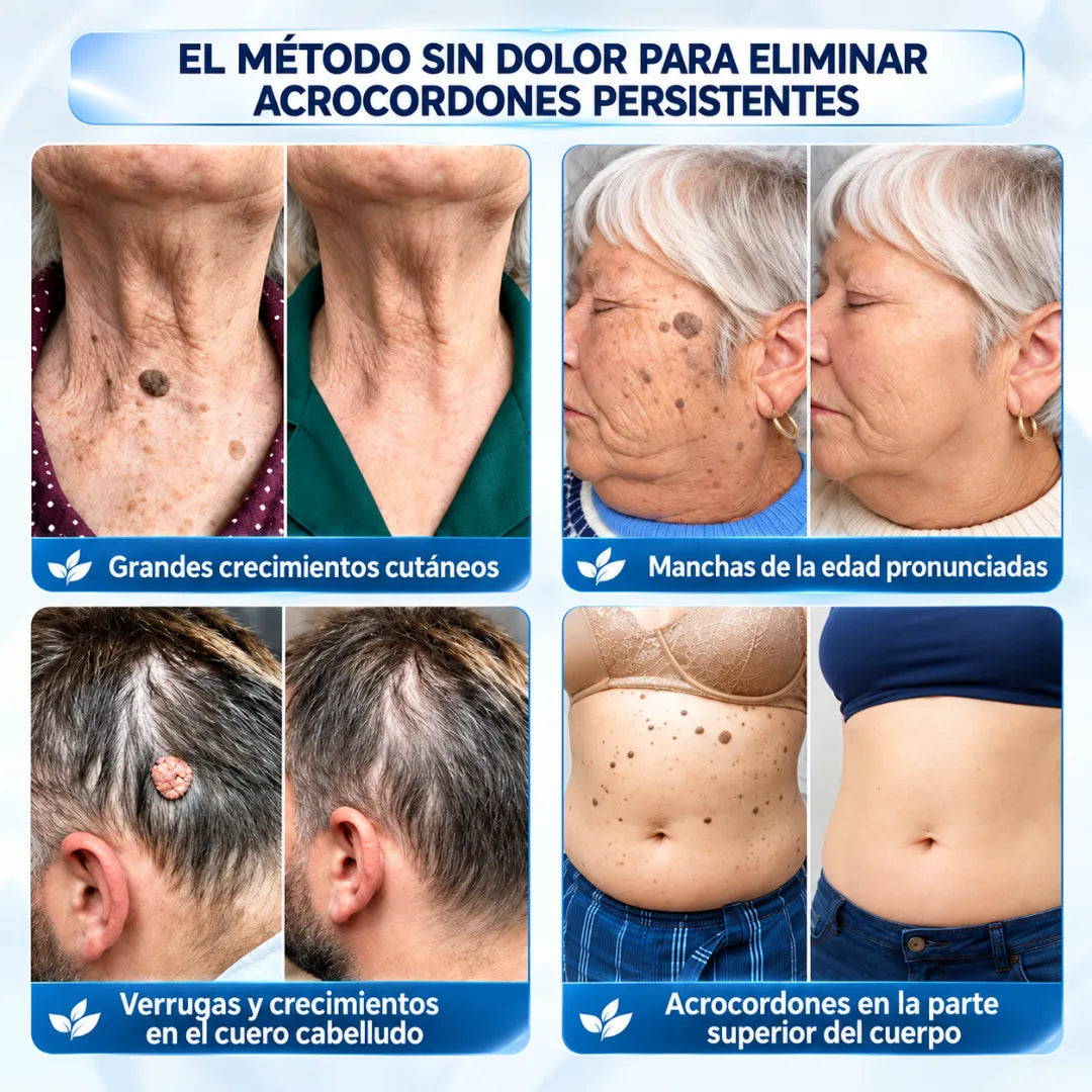 ClaraMaison® CREMA BORRADORA DE ACROCORDONES Y MANCHAS -Sin dolor y sin cicatrices · Crema de alta calidad contra las imperfecciones de la piel